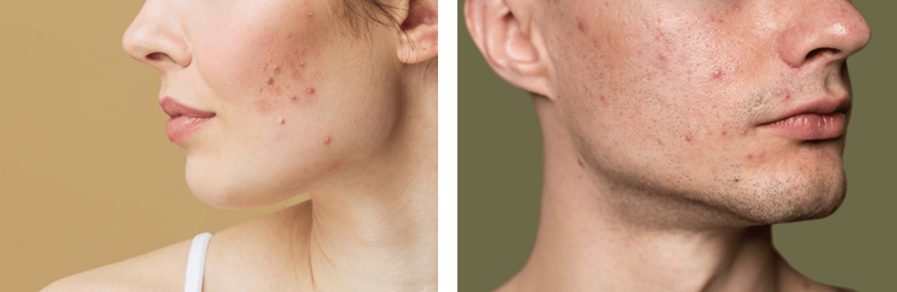 Photo composite d’une jeune femme et d’un jeune homme avec de l’acné sur la joue